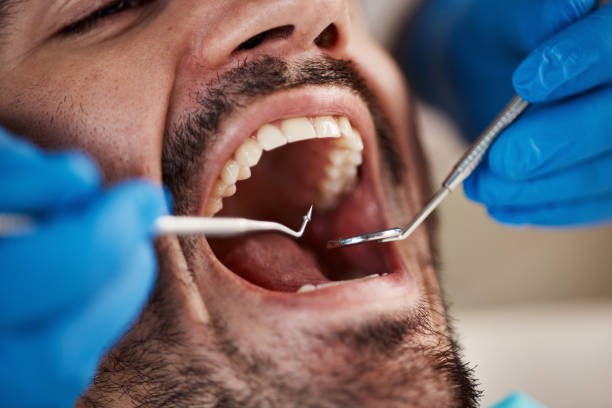 Best Emergency Dental Care for Broken or Chipped Teeth in Union City, CA